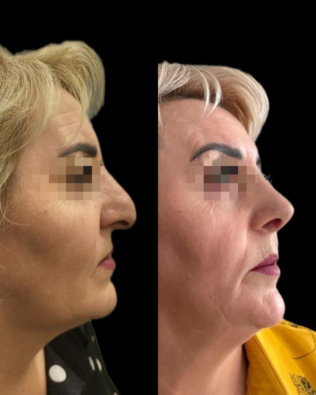 Ռինոպլաստիկա, արդյունքը 2 ամսից